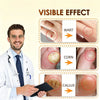 Bee Venom Corn and Callus Removal Cream